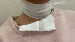 体验后-郡艺医疗美容·微整·眼鼻吸脂