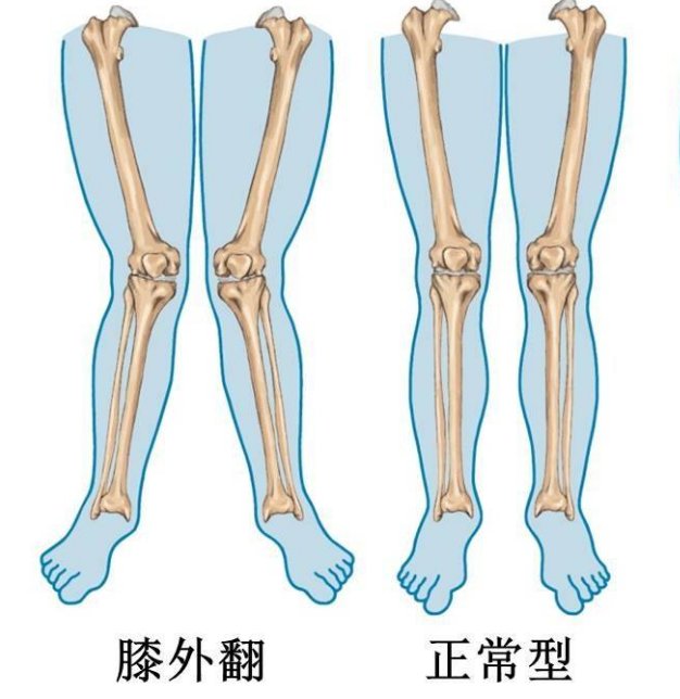 女生股四头肌外翻矫正图片