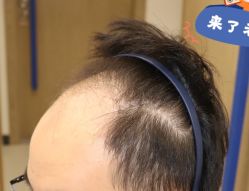 -大麦微针植发全国连锁