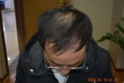 体验前-大麦微针植发全国连锁