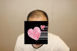 -大麦微针植发丨全国连锁