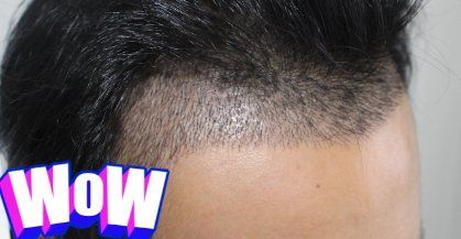 -大麦微针植发丨全国连锁