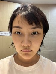 体验后-叶美人医疗美容