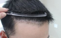 -大麦微针植发丨全国连锁