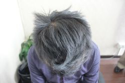 点击看大图 -大麦微针植发丨全国连锁