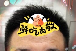 -大麦微针植发全国连锁