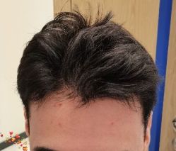 -大麦微针植发丨全国连锁