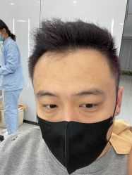 -大麦微针植发丨全国连锁