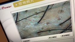 -大麦微针植发丨全国连锁