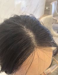 -大麦微针植发丨全国连锁