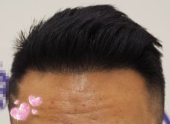 -大麦微针植发全国连锁