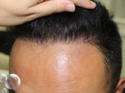 -大麦微针植发丨全国连锁