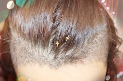 -大麦微针植发全国连锁