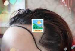 -大麦微针植发全国连锁