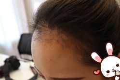 -大麦微针植发丨全国连锁