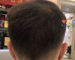 点击看大图 -大麦微针植发全国连锁