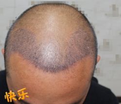 -大麦微针植发丨全国连锁