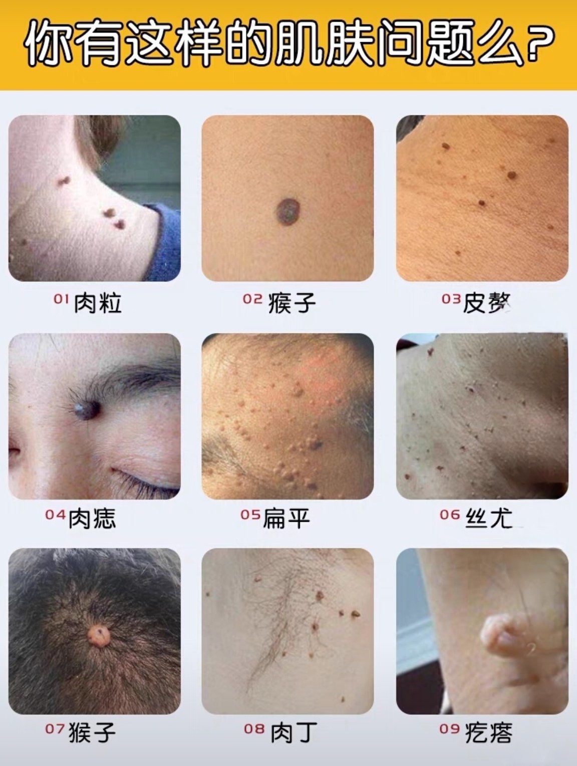 扁平疣初期症状