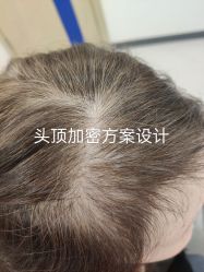 体验前-大麦微针植发全国连锁