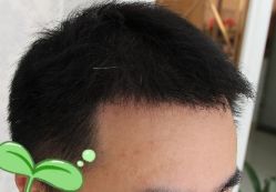 -大麦微针植发丨全国连锁