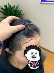 -大麦微针植发全国连锁