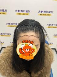 体验后-大麦微针植发全国连锁