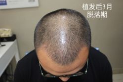 -大麦微针植发全国连锁