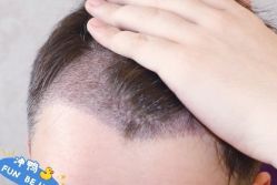 -大麦微针植发丨全国连锁