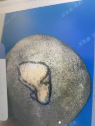 -碧莲盛·不剃发植发