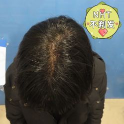 -碧莲盛·不剃发植发