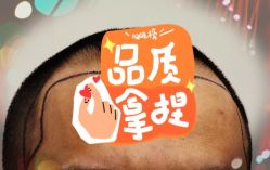 -大麦微针植发全国连锁