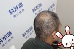 -大麦微针植发丨全国连锁