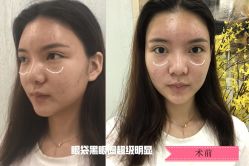 -广州健丽·去眼袋医疗美容机构