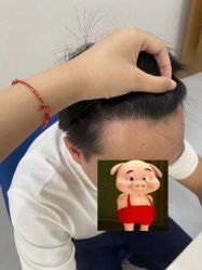 点击看大图 -大麦微针植发全国连锁