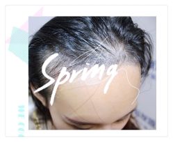 体验后-大麦微针植发全国连锁