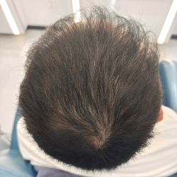 -大麦微针植发全国连锁