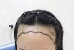 -大麦微针植发全国连锁