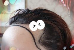 -大麦微针植发全国连锁