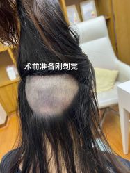 -大麦微针植发全国连锁