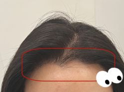 -大麦微针植发全国连锁