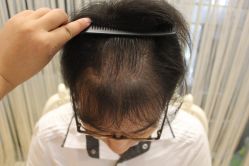 点击看大图 -大麦微针植发丨全国连锁