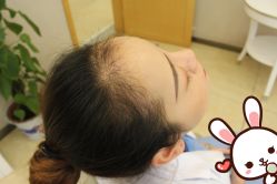 点击看大图 -大麦微针植发丨全国连锁