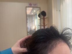 -碧莲盛·不剃发植发