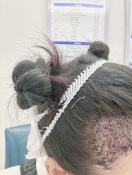 -大麦微针植发丨全国连锁