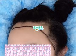 -大麦微针植发全国连锁