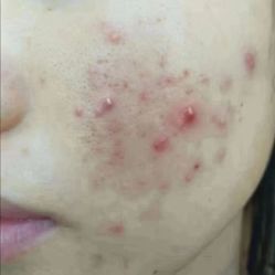 -痘庄科学祛痘国际连锁