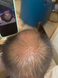 -碧莲盛·不剃发植发