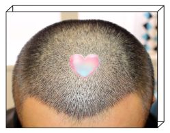 -大麦微针植发全国连锁