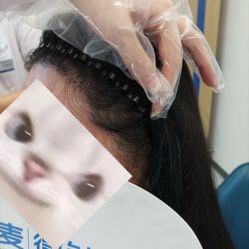体验后-大麦微针植发全国连锁
