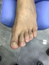 -德哥灰指甲脚气甲沟炎跖疣护理